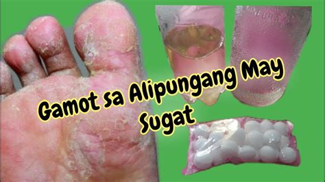 gamot sa sugat na may nana|Sugat Sa Paa: Sanhi, Sintomas, Gamot At Home .